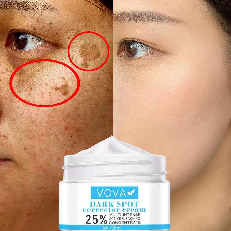 VOVA Effective Whitening Freckle Cream Remove Melasma Acne Spot Pigment Melanin Dark Spots Pigmentation Moisturizing Gel