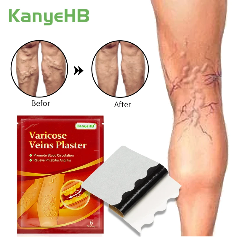 6pcs Treatment For Varicose Veins Chinese Herbal Medicine Varicosity Angiitis Removal Phlebitis Spider Leg Veins Pain Plaster