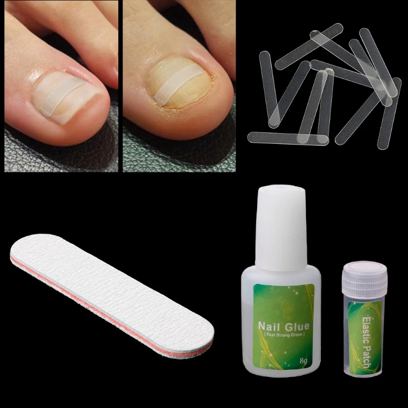 12/24/36pcs Ingrown Toenail Straightening Clip Correction Paronychia Curved Feet Care Tool Toenail Straightening Clip