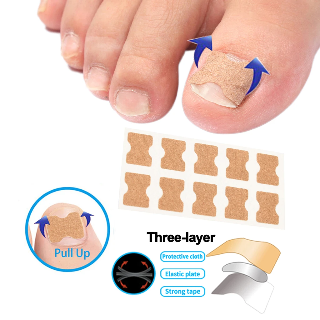 10/50/100 Toenail Patch Ingrown Toenail Correction Pedicure Tool Toe Inlay Nail Corrector Nail Patch Correction Stickers