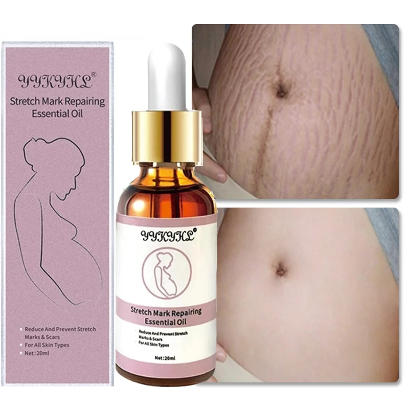 Stretch Marks Remover Essential Oil Skin Care Treatment Cream For Stretch Mark Removal Maternity Slackline For Pregnant Oils