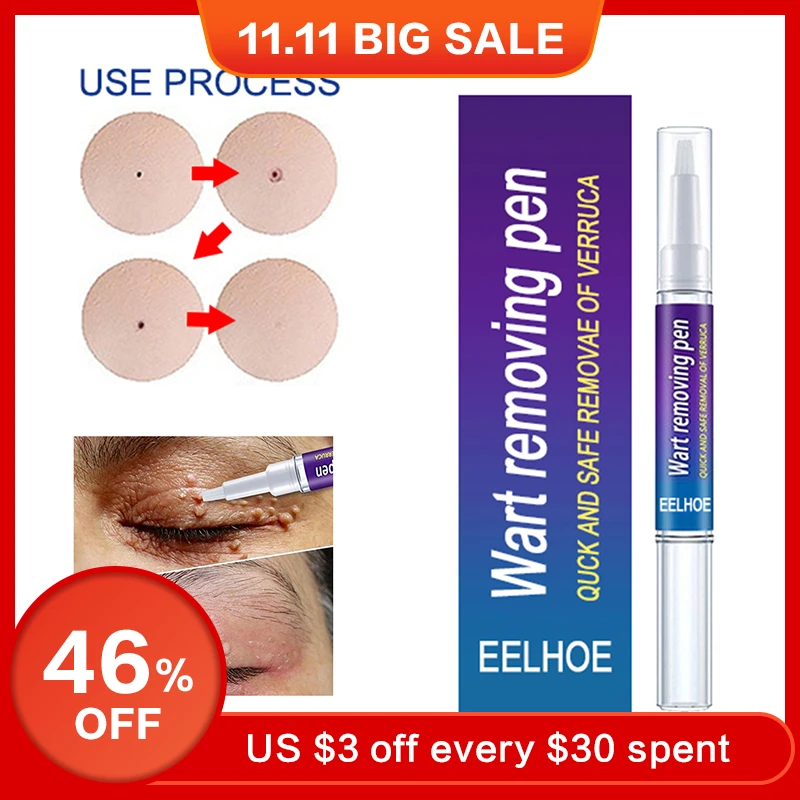 1pc Wart Removal Pen Treatment Papillomas Removal Of Warts Skin Tags Removing Against Moles Remover Anti Verruca
