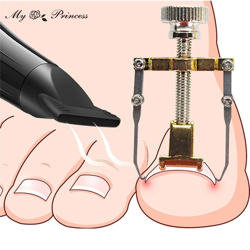 Ingrown Toenail Corrector Pedicure Toenail Fixer Foot Nail Care Orthotic Stainless Steel Treatment Onyxis Bunion Correction Tool