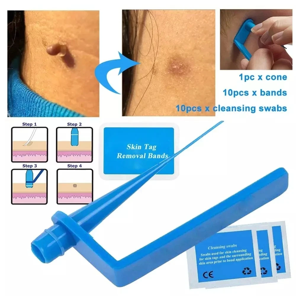 Micro Band Non Toxic Face Care Mole Wart Tool For Small To Medium Blue Skin Tag Removal Kit With Cleansing Swabs Home Use Adult