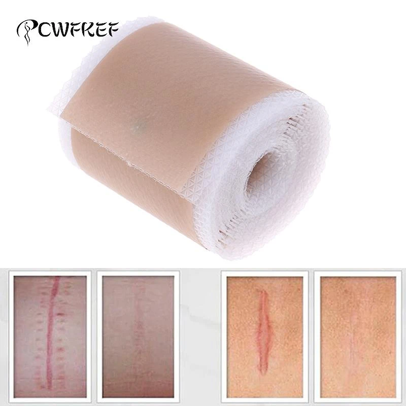 Efficient Surgery Scar Removal Silicone Gel Sheet Therapy Patch for Acne Trauma Burn Scar Skin Repair Scar Treatment 4x150cm